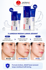 Lion Acne Cream Original Japan – Obat Totol Jerawat Spot Treatment 14g / 24g
